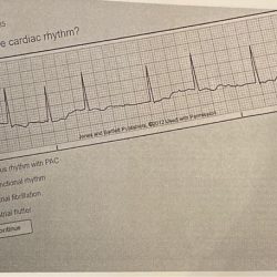 Relias dysrhythmia - basic b test answers course hero