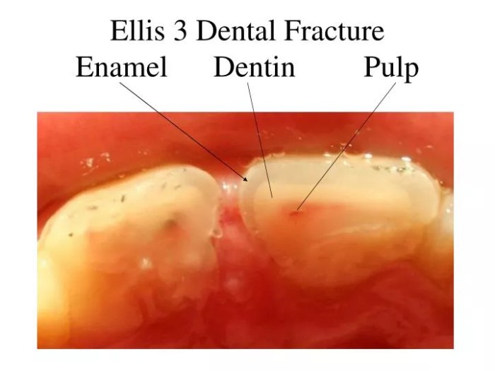 In what order does a dentist drill through tooth layers